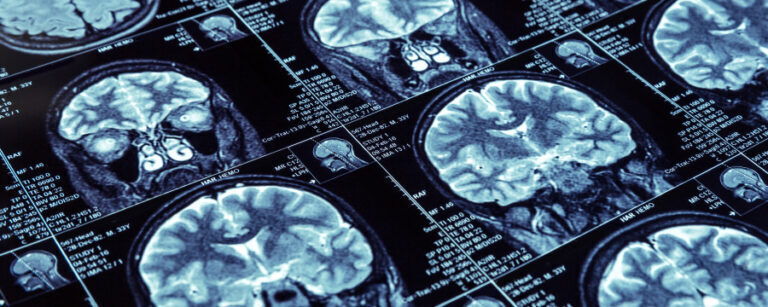 Abogado de Lesiones cerebrales traumáticas en Boston